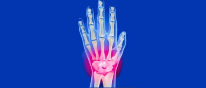 Wrist Conditions and Physical Therapy