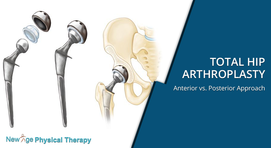 Total Hip Arthroplasty